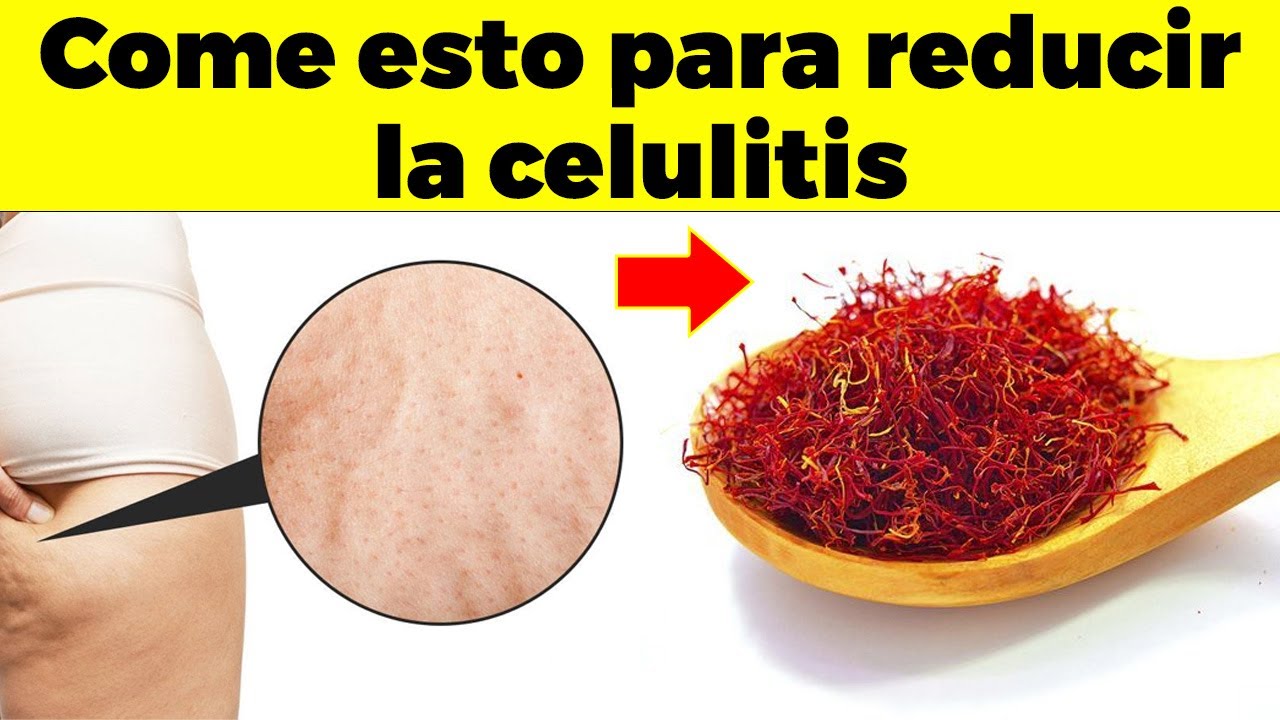 alimentos que producen celulitis en las piernas