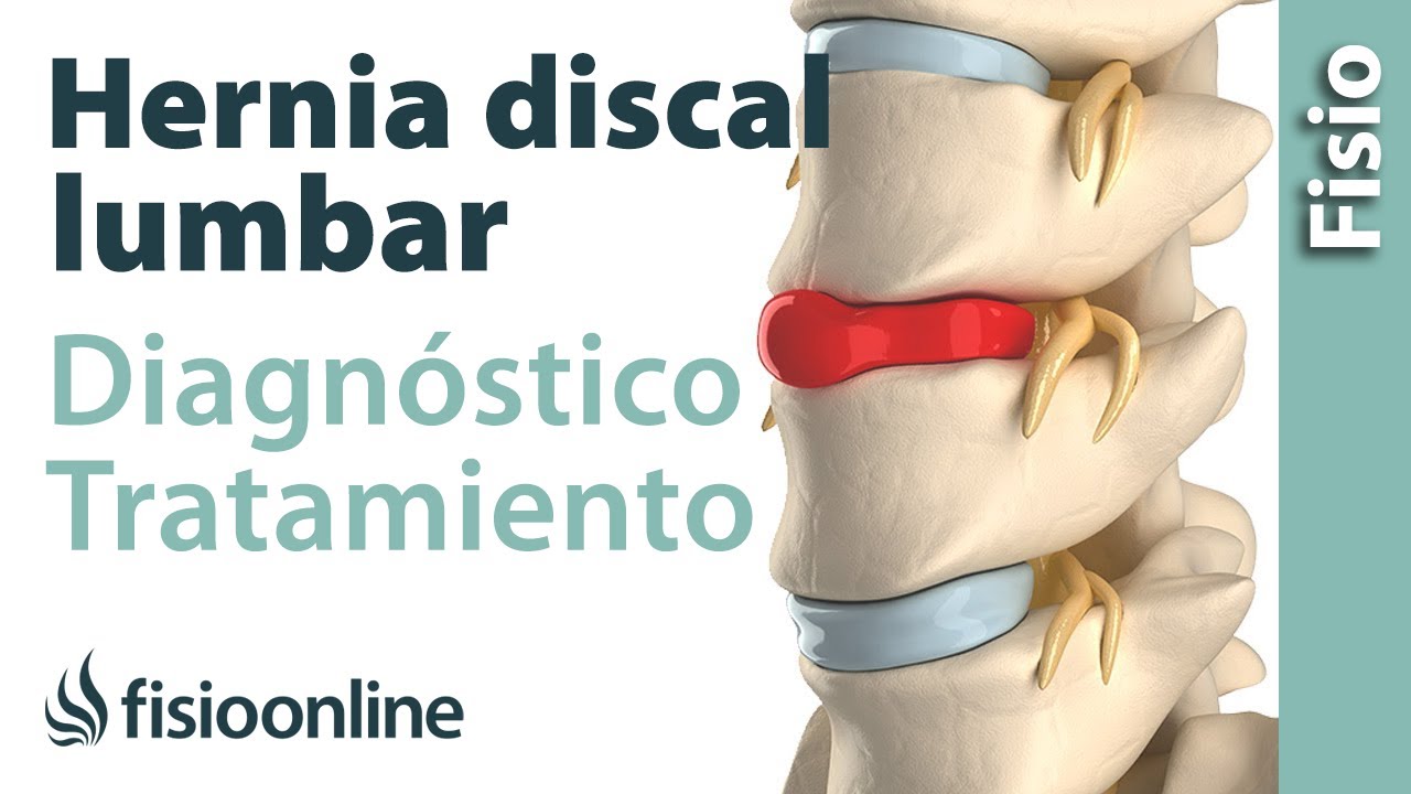 como tratar una hernia discal lumbar