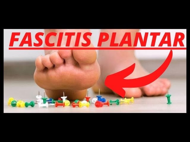 cuanto tarda en curarse la fascitis plantar