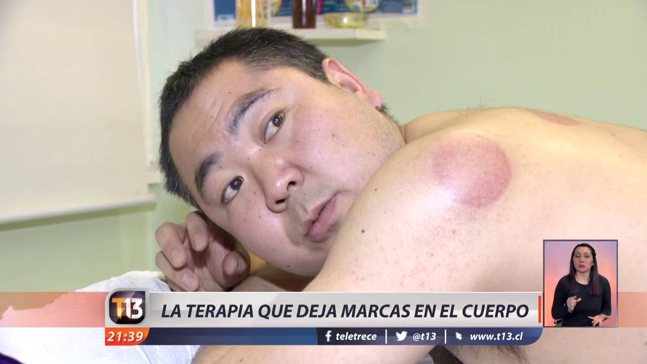 cuánto tiempo se deja una ventosa en el cuerpo