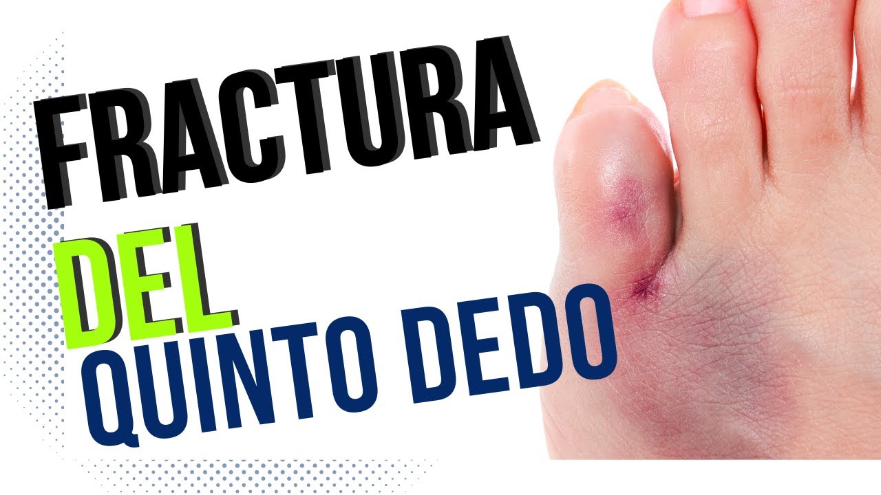 dedo meñique del pie roto vendaje