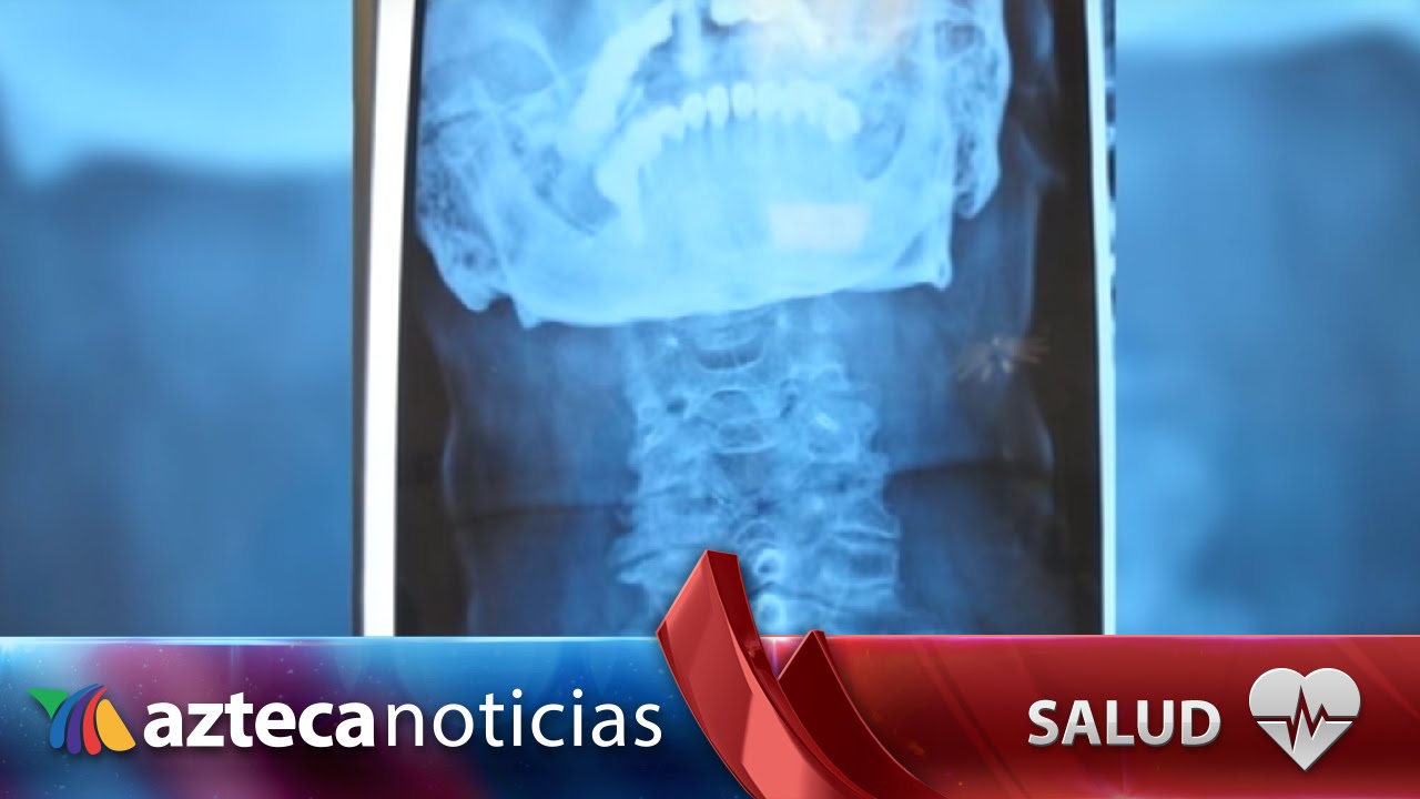 dolor de cervicales y hormigueo en las manos