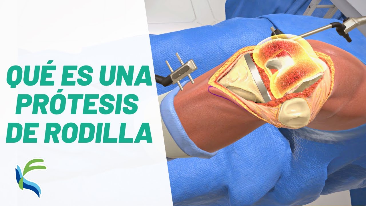 en que consiste la operacion de protesis de rodilla