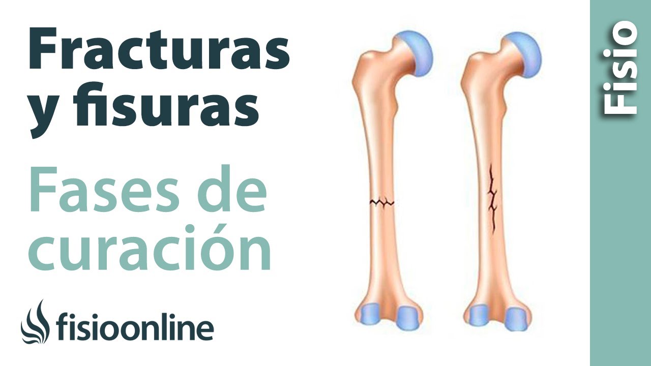 es lo mismo fisura que fractura