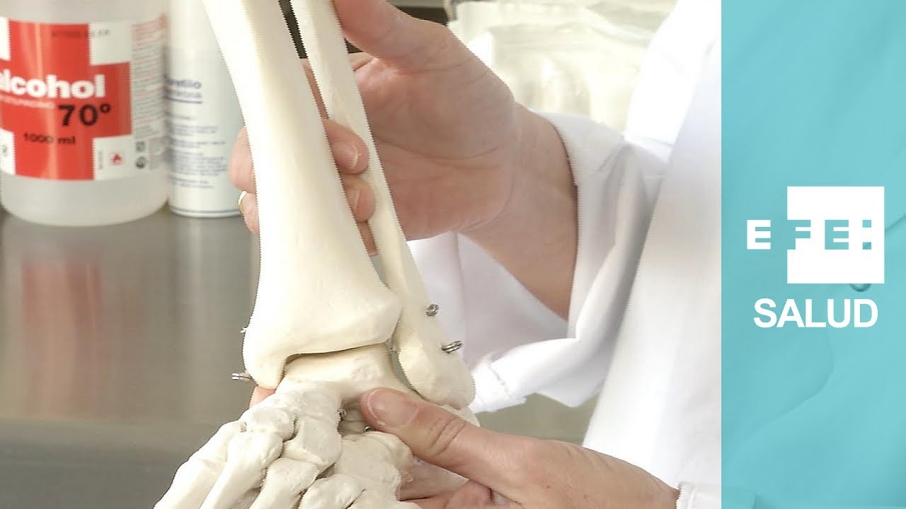 esguince de tobillo con fractura de perone