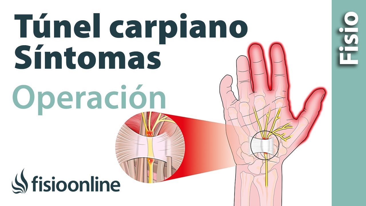 fibrosis tras una operacion de tunel carpiano