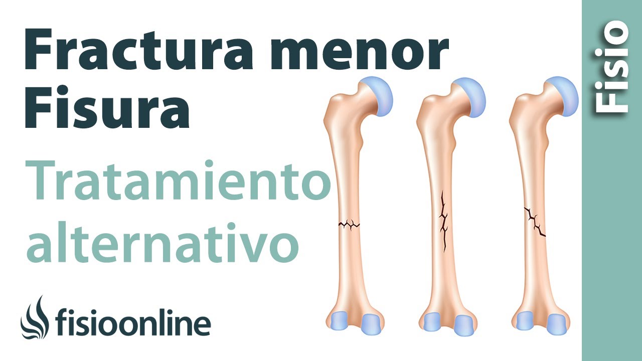 fisura en la tibia por golpe