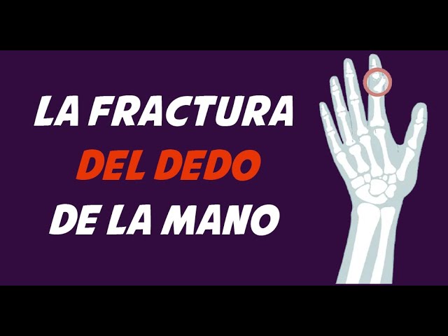 fractura de dedo de la mano
