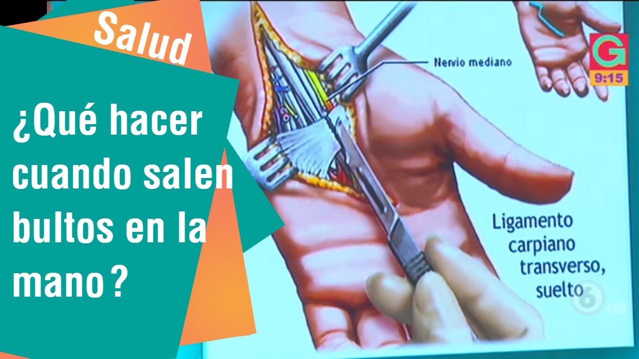 ganglios en la palma de la mano
