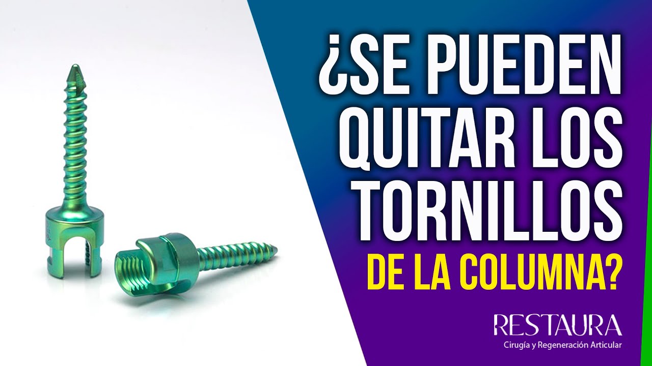 los tornillos puestos por una artrodesis lumbar son para siempre