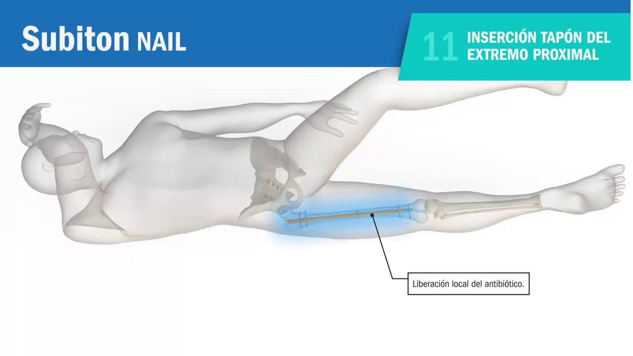 operacion de femur con clavo intramedular