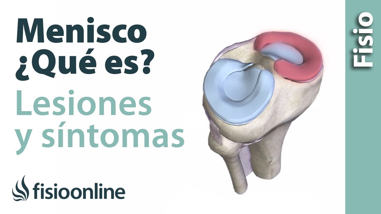 problema de meniscos en la rodilla sintomas