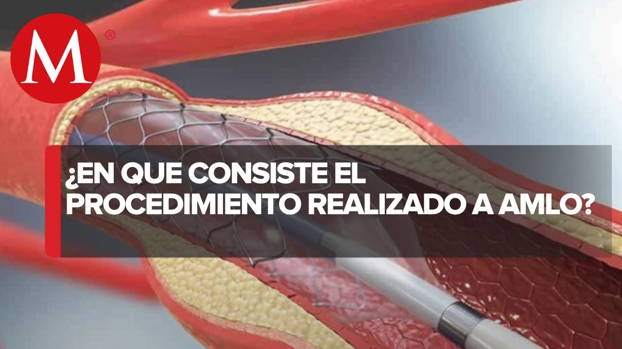 que es un cateterismo en el corazon