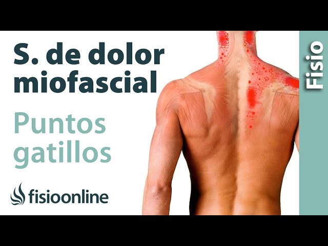 que son los puntos de gatillo