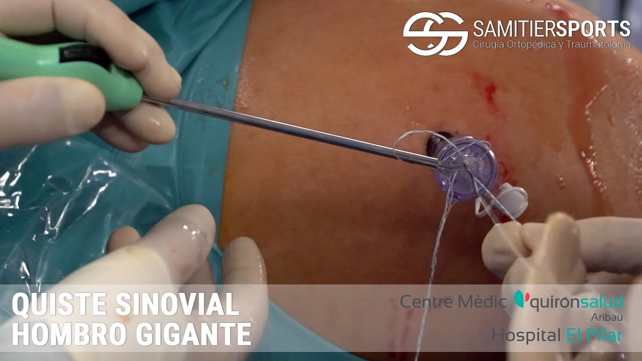 quiste en el hombro con dolor