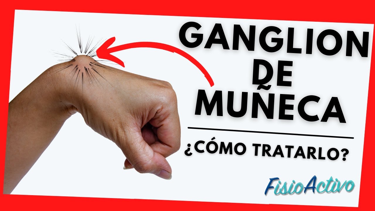 quiste sinovial dedo mano remedios caseros