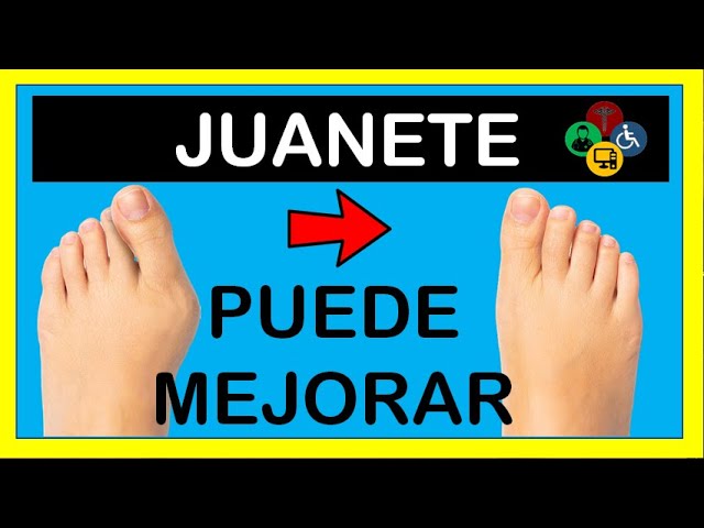 remedios caseros para el dolor de juanetes