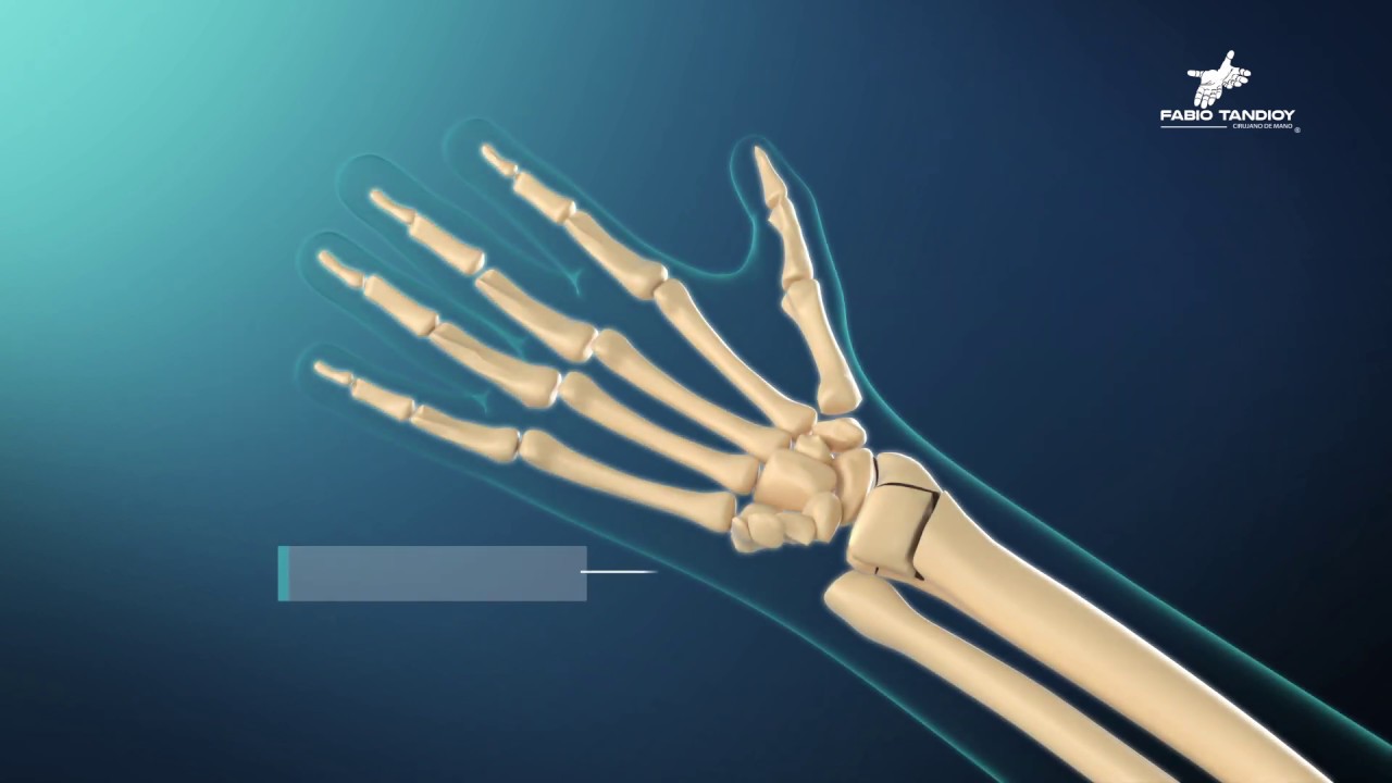 rotura del radio de la mano