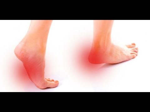 se puede caminar con fascitis plantar