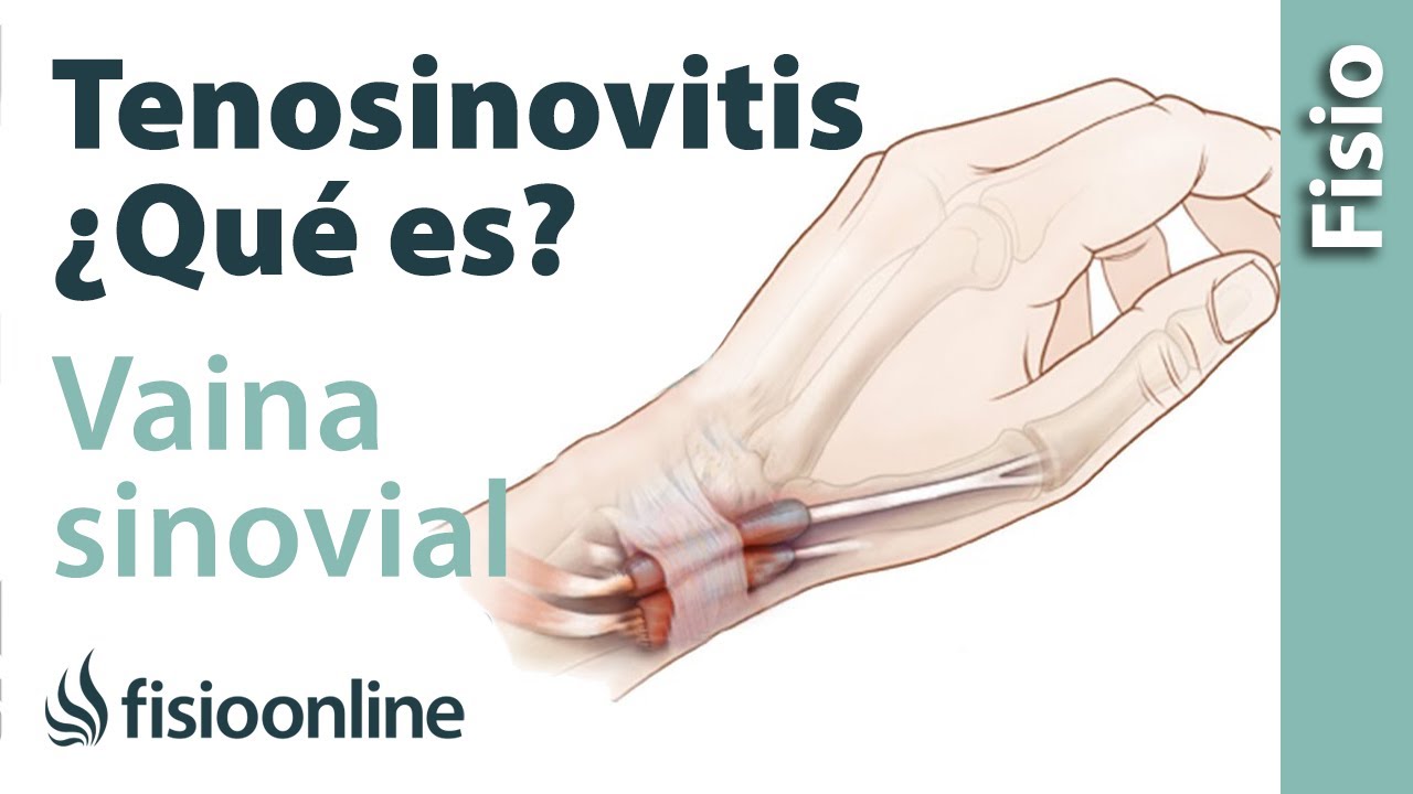 sinovitis y tenosinovitis de mano muñeca