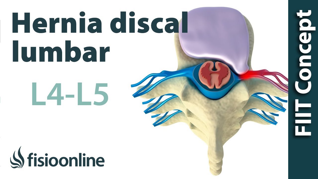 sintomas de hernia discal lumbar l4 l5 s1