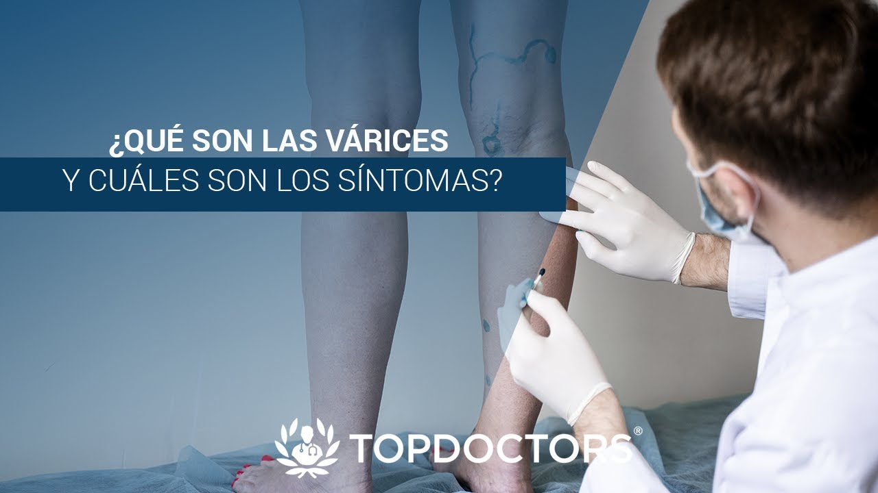 sintomas de varices en los pies