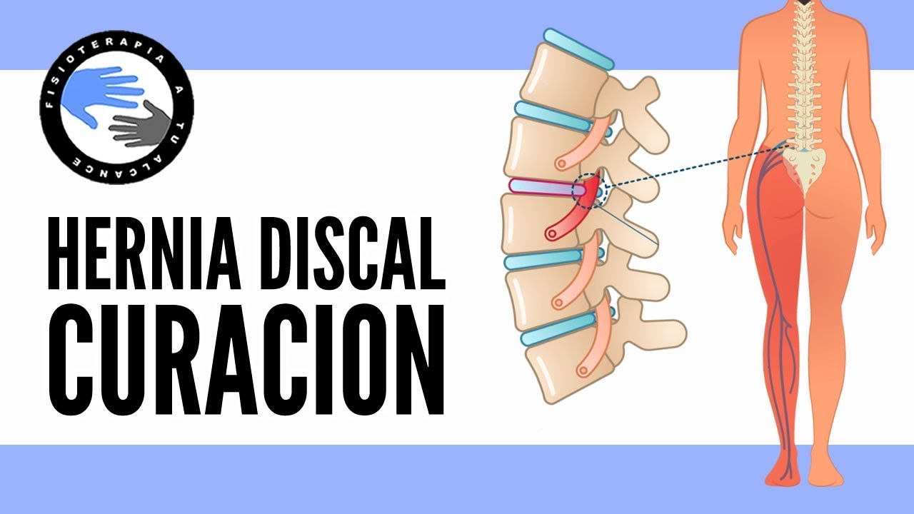 tiempo de baja por hernia discal cervical