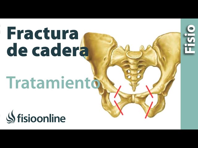 tiempo de reposo en fisura de pelvis