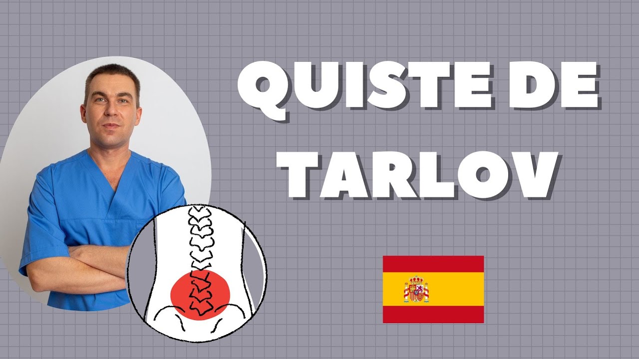 quistes de tarlov en sacro tiene reflejos en abdomen
