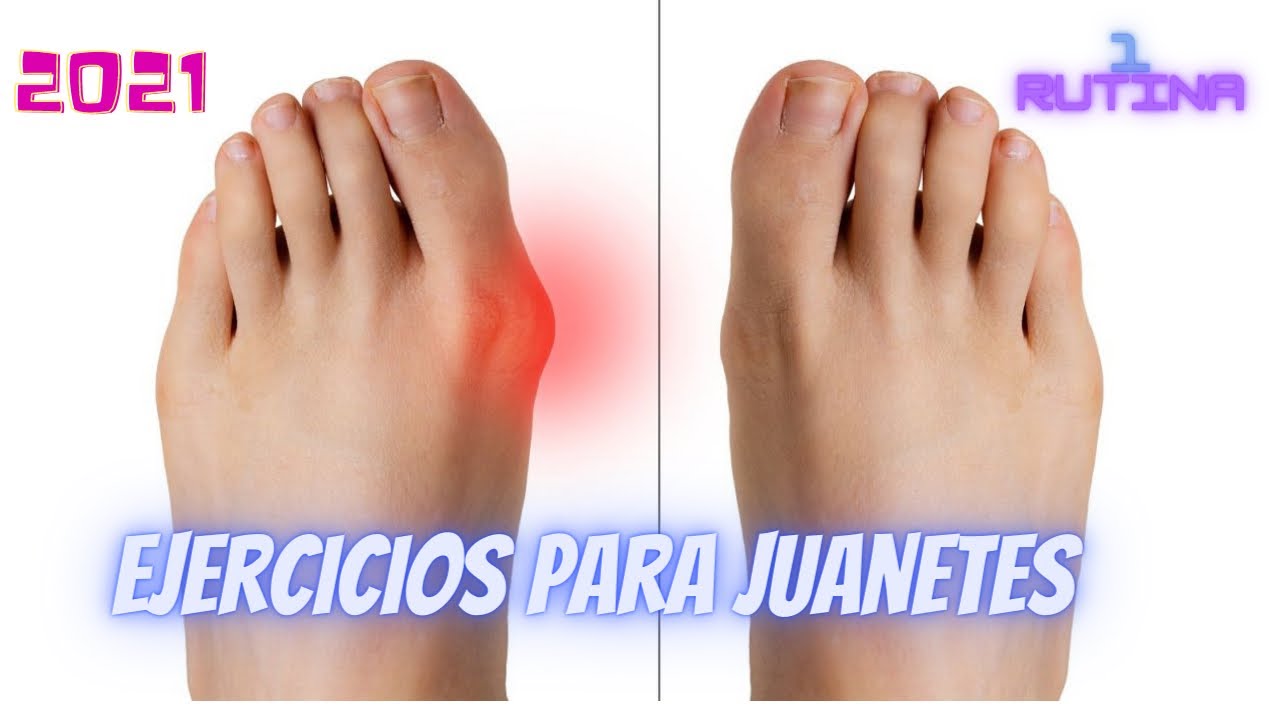 remedios para juanetes en los pies