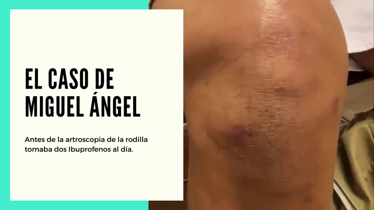 rodilla con artrosis y menisco roto